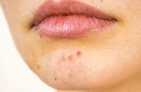 5 vragen die je jezelf wilt stellen als je last hebt van acne